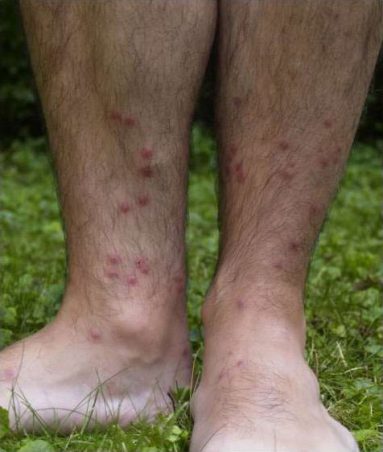 poison ivy pictures rash stages